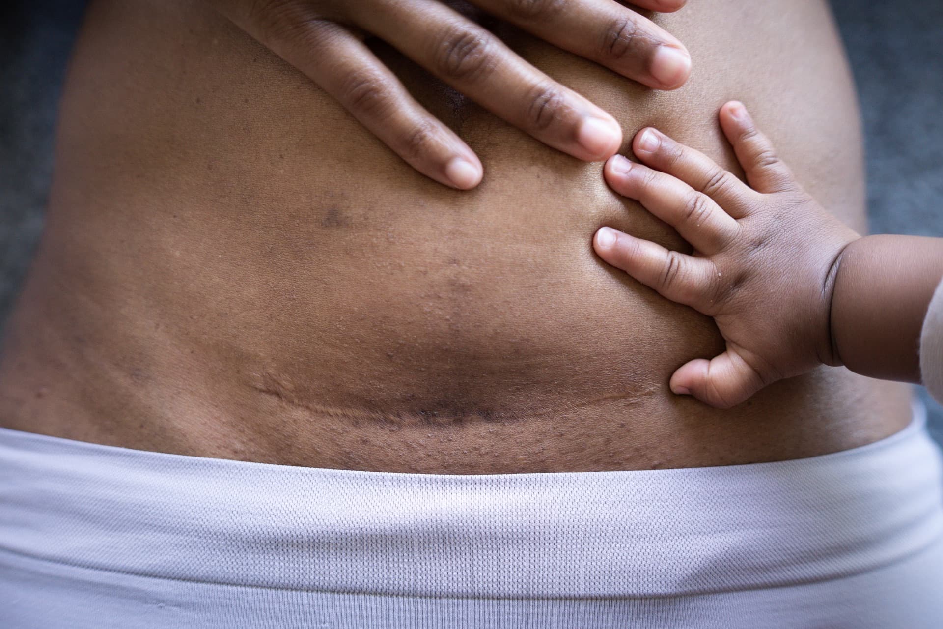 Mother's caesarean scar with her baby's hand resting beside it